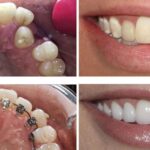 Factors Affecting Dental Aligners Cost in India